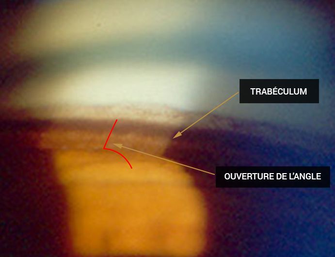 trabéculum : filtre de l’œil par lequel passent les liquides. angle irido-cornéen normal, l’angle est ouvert