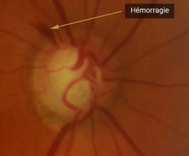 la micro-hémorragie du nerf optique signe un glaucome non équilibré